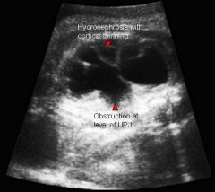 UPJ obstruction

Enlarged renal pelvis with or without enlargement of the calyces 
DDX:
Multicystic dysplastic kidney

Renography with either DTPA or MAG:
Definitive diagnosis
Inadequate drainage of the kidney seen on time activity curves with ima