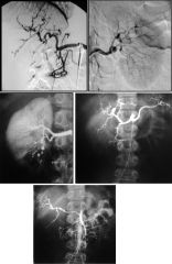 Polyarteritis nodosum

Case findings: 
Multiple micro aneurysms involving the segmental and subsegmental branches of the right kidney

DDX:
Polyarteritis nodosum
Diffuse multiple septic emboli, SLE
Necrotizing angiitis (methamphetamine)  speed ki
