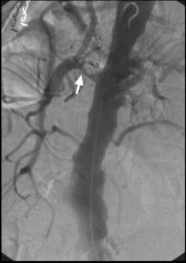 Chronic mesenteric ischemia

Lateral abdominal aortogram shows occlusion of the celiac and IMA
Severe stenosis of the proximal SMA is present (arrow)
Clinical: postprandial pain  intestinal angina, weight loss 
Angiography: tight origin of the celia