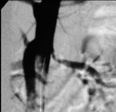Renal artery stenosis

Case finding: ostial renal artery stenosis secondary to atherosclerosis

Etiology: MC atherosclerosis, FMD, NF
Treatment: 
Aorto-renal bypass
FMD: PTA (5-year patency 80-90%)  non-ostial lesions
Atherosclerosis: endovascula