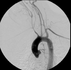 Takayasu’s arteritis

Case findings: 
Tight stenoses of the BCA extending to the carotid-subclavian artery bifurcation 
Tapered stenosis of the left CCA

Granulomatous vasculitis
MC women < 50 year old, elevated ESR

Angiography:
MC affect aorta