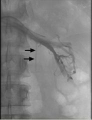 Male varicocele

Case findings: 
Distal injection of the left gonadal vein showed collateral veins, with a varicocele (tangle of vessels)
Varicocele:
Dilatation of the pampiniform plexus (MC left)
Infection of left renal vein with reflux into left g