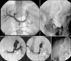 Gastric and esophageal varices

Case findings (portal venogram):
Numerous tortuous, dilated vessels with retrograde flow in region of the gastric fundus and GEJ
Large collateral vein extending inferiorly from splenic hilum to left renal vein

Gastri