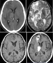 Lymphoma

Primary lymphoma: 
MC NHL
Parenchymal location: MC basal ganglia, periventricular deep WM, corpus callosum

Metastatic lymphoma: 
Either dural-based or leptomeningeal 
When parenchymal, are usually associated with leptomeningeal disease 