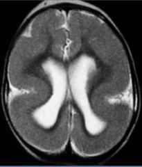 Cortical dysplasia

Case findings:
Thick, broad, gyri on coronal FLAIR 
Diffuse high T2-weighted signal in the occipital cortex

Focal or generalized malformations of the cerebral cortex 
Junction of the grey/white matter is indistinct 

Types:

