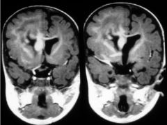 Gray matter heterotopia

Case findings: multiple irregular nodules in the subependymal region in the ventricular walls 

Collection of GM in ectopic locations secondary to arrest of radial migration of neurons
May be isolated or seen with structural 