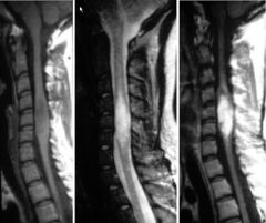 Spinal cord ependymoma 

Intramedullary spinal cord tumor:
MC ependymoma, astrocytoma
LC hemangioblastoma
Focal enlargement of the spinal cord with low T1 and high T2 signal
Spine adult: MC ependymoma
Spine child: MC astrocytoma

Spinal cord ast