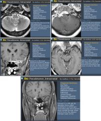 Meningioma

Case findings:
Enhancing mass adjacent to left anterior clinoid process with eccentric suprasellar extension to the left and left inferior extension into the cavernous sinus
Mass envelops left cavernous ICA inferiorly, the supraclinoid ICA