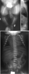Achondroplasia

Skull:
Narrow foramen magnum, small posterior fossa
Spine:
Narrow spinal canal with spinal canal stenosis
Narrowing of the interpedicular distances in the lumbar region
Bullet shaped vertebral bodies early, which progress to short f