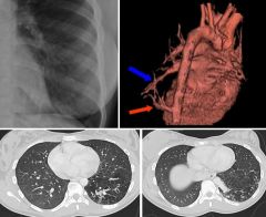 12 year old girl with recurrent left lower lobe pneumonias