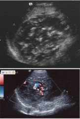 Infantile hemangioendothelioma

Case findings:
Axial T2: well circumscribed mass in left lobe with slightly heterogenous, but increased SI. Numerous, prominent flow voids within the mass
Coronal T1: large, slightly nodular, well circumscribed mass wit
