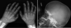 Hunter’s syndrome

Case findings: 
Broad ribs which taper posteriorly
Clavicles are short and broad 

Dysostosis multiplex: pattern of skeletal abnormalities in mucopolysaccharadoses
Skeletal manifestations of Hunter’s syndrome are moderate in seve