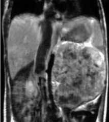 Wilms’ tumor

MC abdominal malignancy
Immature renal elements (nephroblastoma): blastema (forms glomeruli), tubules, stroma
Clinical presentation: painless abdominal mass, hypertension (from tumor renin production)

Features:
Well-defined, appears 