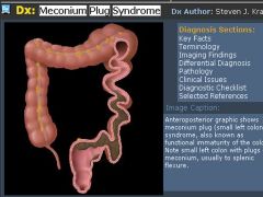 Small left colon syndrome

Case findings:
Narrow microcolon to just below the splenic flexure
Large meconium plug in the proximal bowel 
Distensible rectum which is unlike Hirschsprung’s disease, in which the rectum does not distend

Small left col