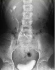 Crossed fused renal ectopia 

US: two kidneys lying in the left abdomen, with fusion of lower pole of LK to the upper pole of the transposed RK

Two kidneys are on the same side of the body (MC right)
Lower element is ectopic
Ureter from this lower 