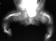 Hypophosphatasia

Severe osteoporosis with delayed bone age
Poor ossification of the skull vault
Multiple fractures and multiple vertebral collapse

Autosomal recessive, 4 types
Defective skeletal mineralization resembling rickets and osteomalacia 