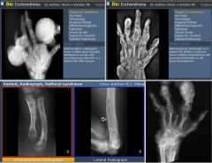 Ollier's disease (enchondromatosis)

Case findings:
Osseous expansion and speckled calcifications in the femur, tibia and fibula due to enchondromas 

Nonhereditary, multiple foci of cartilage within bones and subperiosteal deposition of cartilage
