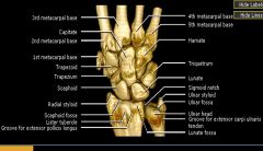 Carpal coalition

Case findings:
Coalition of the lunate and triquetrum 
Hypoplastic scaphoid, overgrowth of the capitate and hamate 

MC lunate and triquetrum 
2nd MC is capitate and hamate  may be associated with Ellis van Creveld 

May occur 