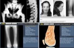 Osteopetrosis (marble bone disease, Albers-Schonberg)

Case findings:
Expansion of the medullary bone with sclerosis of marrow cavity
Erlenmeyer flask 
Hair-on-end

DDX osteosclerosis:
Osteopetrosis 
Pyknodysostosis 
Melorheostosis
Engleman’s 