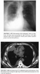 A 6 1 -year-old man presents with progressive shortness of breath.