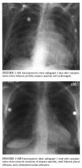 A 35-year-old woman status post bilateral lung transplantation for pulmonary
hypertension.