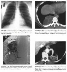 A 25-year-old man and a 60-year-old woman with cough, fever, and chest pain.
Both have a history of recurrent pneumonia in the same pulmonary segment