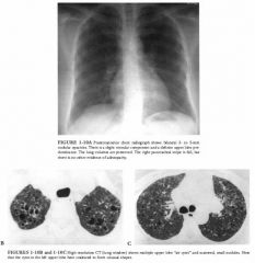 A 25-year-old woman with progressive dyspnea