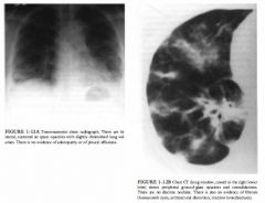 A 53-year-old woman with progressive dyspnea, cough, and low-grade fever over
the past 8 weeks.