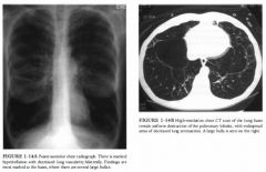 A 40-year-old woman with a history of cigarette smoking and progressive dyspnea