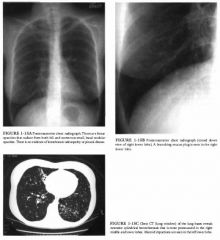 A 23-year-old woman with sinusitis and recurrent respiratory infection