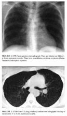 Previously healthy 27-year-old woman presents with weight loss, malaise, and nonproductive
cough.