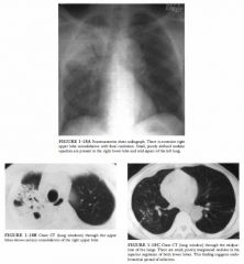 A 56-year-old man presents with fever, weight loss, and productive cough.