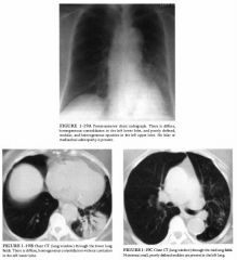 A 75-year-old woman with mild dyspnea, chronic weight loss, and no history of fever.