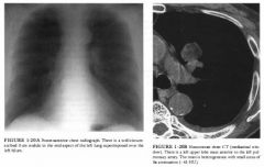 Asymptomatic 71 -year-old man undergoes a routine annual chest radiograph