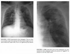 A 60-year-old man who is a foundry worker presents with progressive dyspnea.