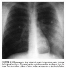 A 23-year-old man presents with an acute onset of productive cough, fever, and
chills. The patient is otherwise healthy and has no prior illnesses.