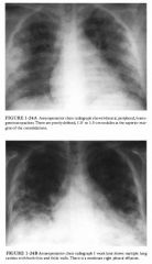 A 25-year-old woman presents with pleuritic chest pain, high fever, nonproductive
cough, and a history of intravenous drug abuse