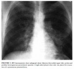 A 32-year-old homosexual man who tested positive for the human immunodeficiency
virus (HIV) 3 years earlier now presents with gradual onset of shortness of
breath and slight fever.