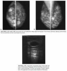 A 45-year-old asymptomatic woman presenting fQr a screening mammogram.
A breast ultrasound was subsequently performed
