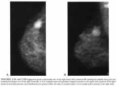 A 43-year-old woman with a palpable lump in the upper outer quadrant of the right
breast presents for diagnostic mammography. There is no past surgical history.