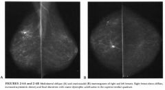 Screening mammogram in a 70-year-old woman, status post right lumpectomy and
radiation therapy for treatment of carcinoma.