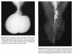 Diagnostic mammogram in a 33-year-old woman with pain in her left breast.
Sixteen years ago she underwent breast augmentation with silicone implants; the
right implant was ruptured and replaced 3 years before the mammogram.