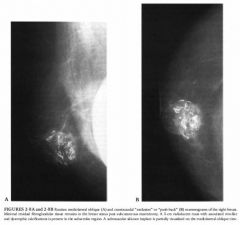 Diagnostic mammogram in a 52-year-old female, status post left mastectomy for
breast cancer and right subcutaneous mastectomy with reconstruction.