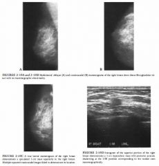 Screening mammogram in a 64-year-old women. A true lateral mammogram was performed
because of a questionable area of distortion anteriorly on the right that did
not persist. A sonogram of the superior right breast was subsequently performed.