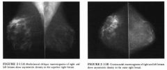 Screening mammogram in a 49-year-old premenopausal woman. She had no
palpable abnormality or history of surgery.
