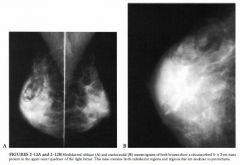 A 43-year-old asymptomatic woman presenting for a screening mammogram.