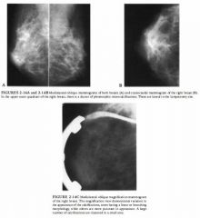 A 45-year-old woman presenting for screening mammography 2 years after lumpectomy
and radiation therapy to the upper inner quadrant of the right breast for carcinoma.