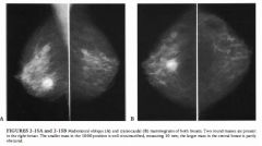 Diagnostic mammogram in a 58-year-old woman with a palpable lump in the right
central breast and a clinical history of melanoma. There were no prior mammograms
for comparison.