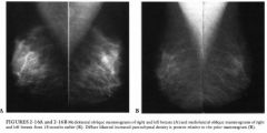 A 73-year-old asymptomatic woman presenting for a screening mammogram who
had begun hormone replacement therapy 1 year previously. She had no family history
of breast cancer.