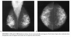 Diagnostic mammogram in a 72-year-old woman who presented with a 2-cm palpable
mass in the upper inner quadrant of the right breast. The family history was
significant for a sister with postmenopausal breast carcinoma.